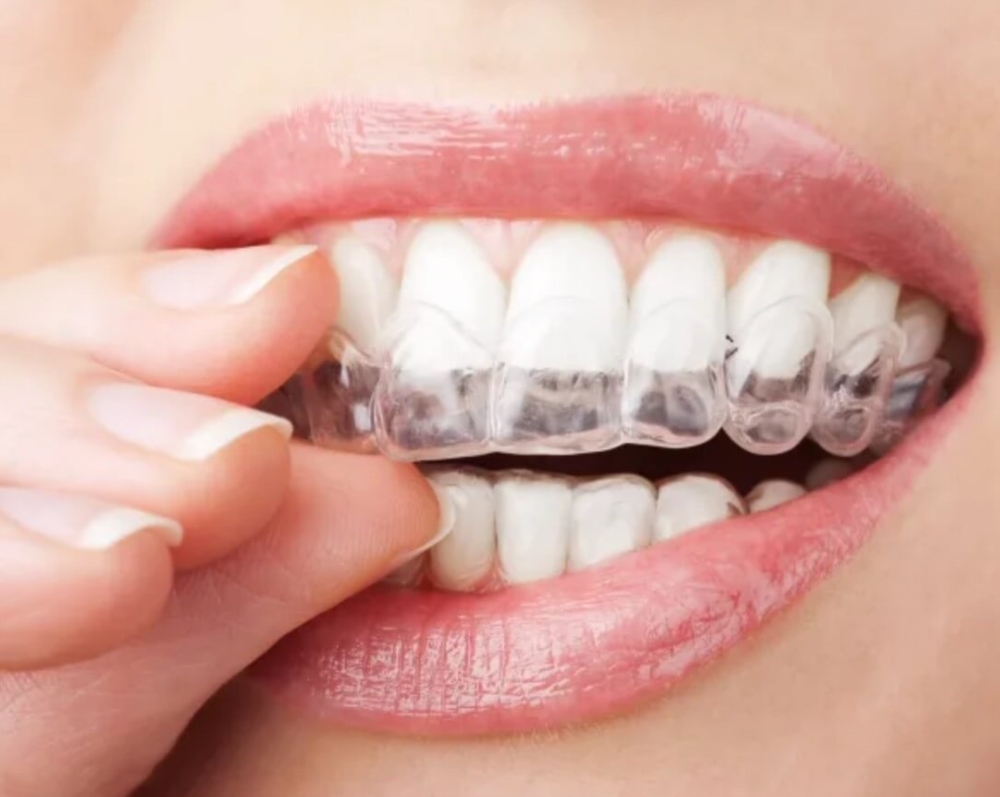 Traitement d’orthodontie invisible au Luxembourg