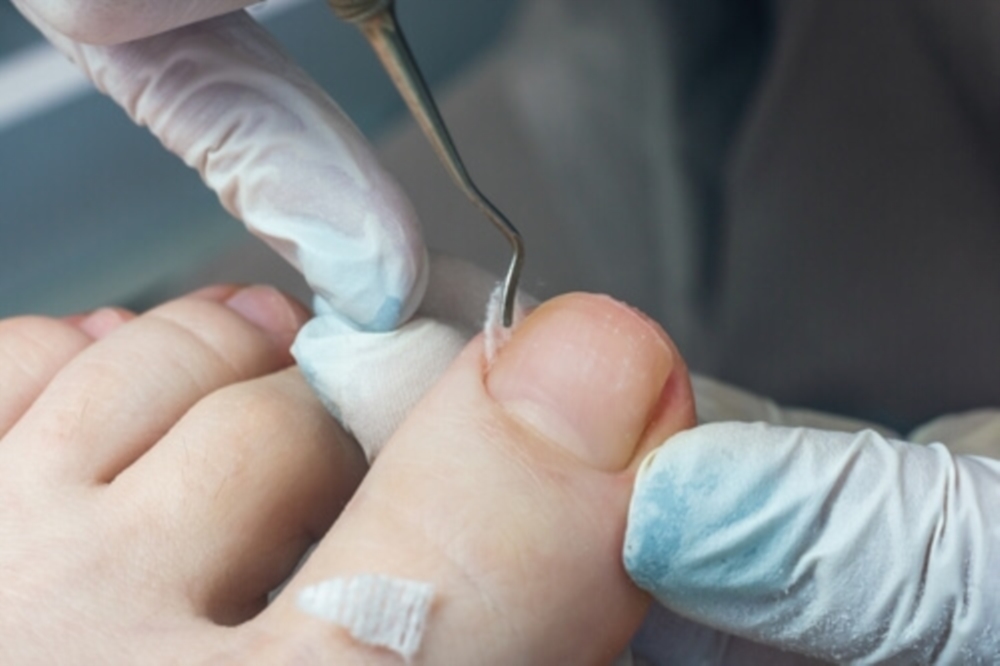 Pédicure médicale