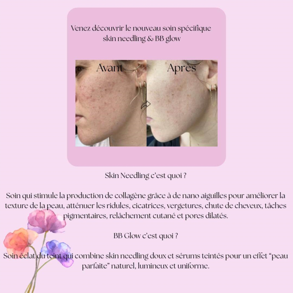 Le Skin Needling – Le soin innovant pour une peau transformé