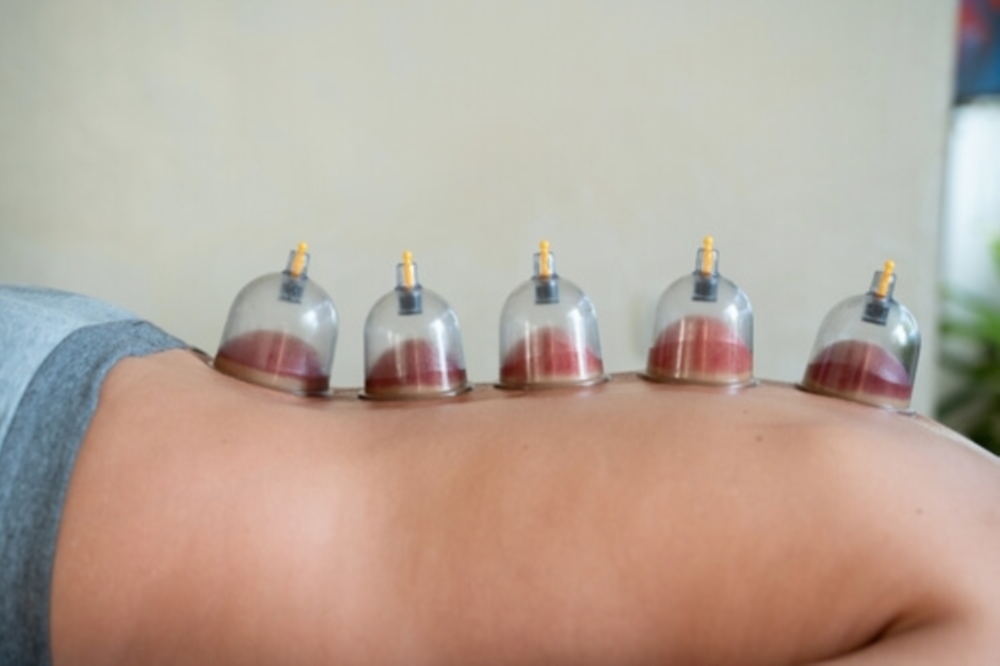 Hijama & Cupping Thérapie (ventouses)