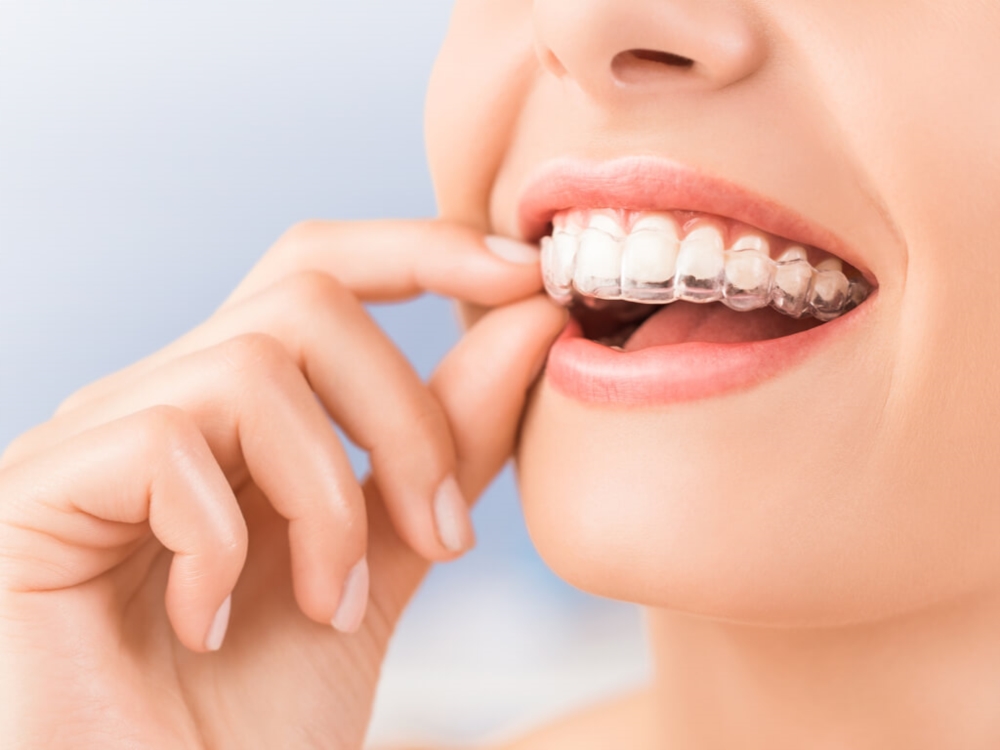 Orthodontie esthétique adulte invisible invisalign