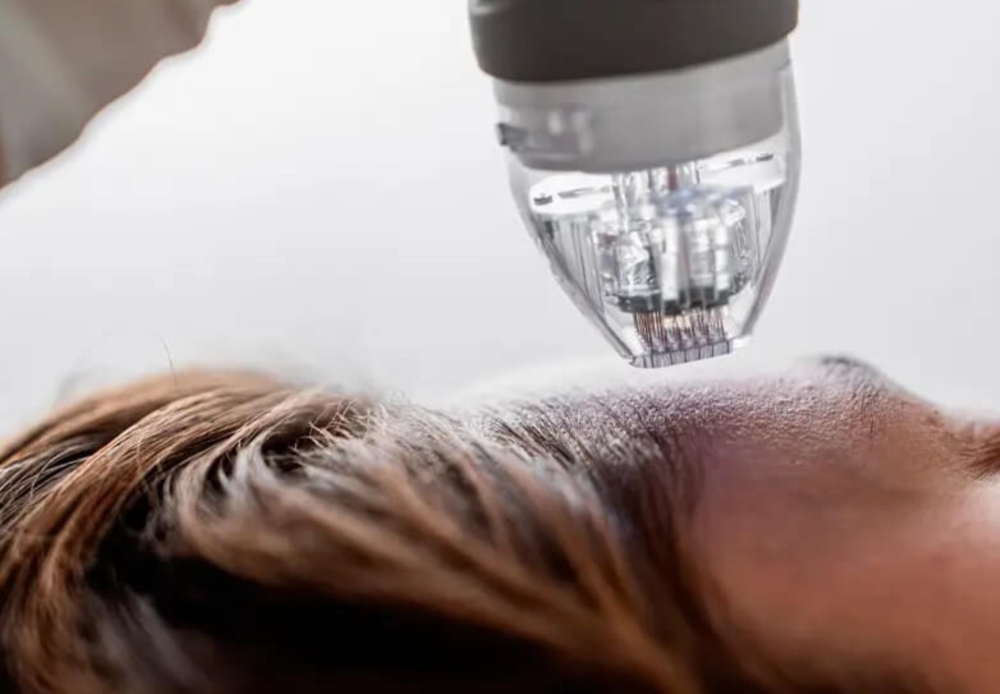 Découvrez le Micro Needling & Radiofréquence fractionnée