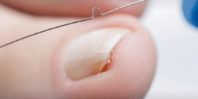 Le traitement des ongles incarnés