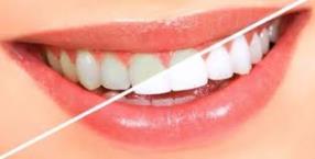 blanchiment dentaire smile & go !
