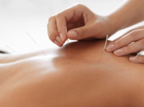 L'acupuncture