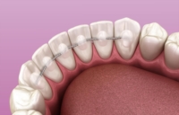 Artikel vu Knick Kevin
